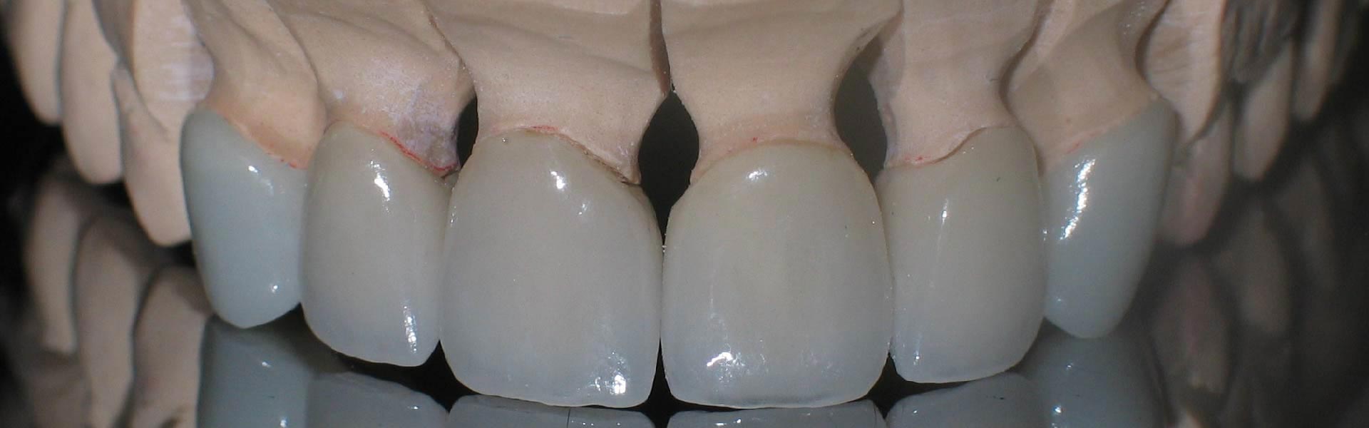 banner prosthetic teeth