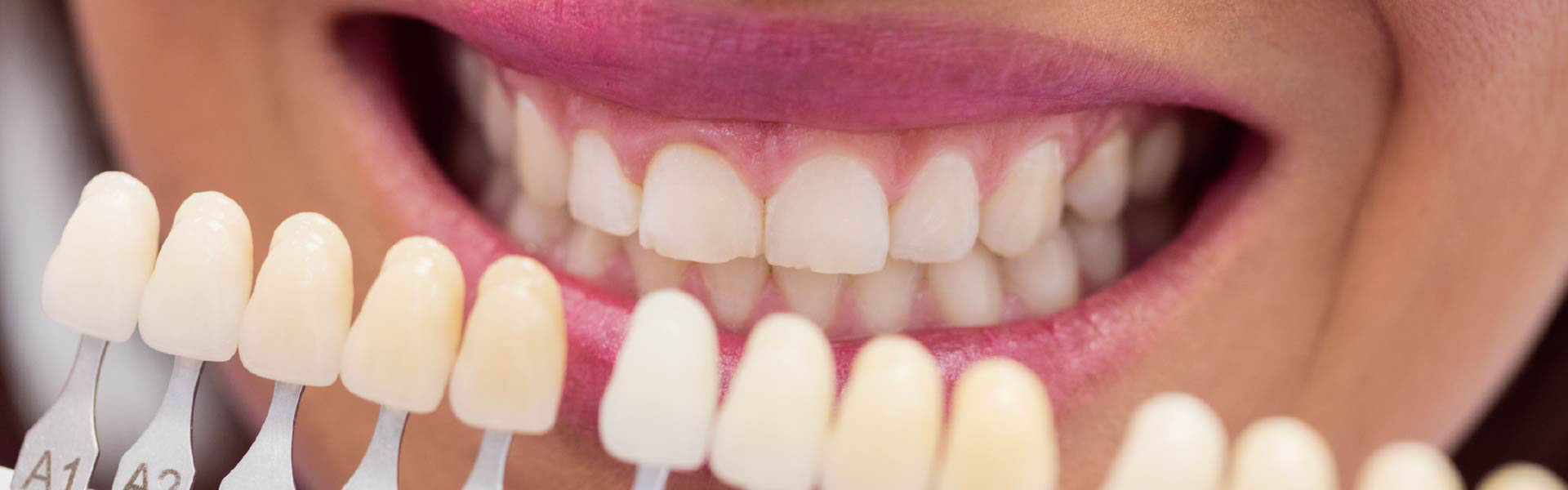 banner teeth whitening